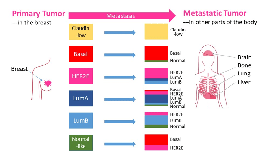 Description of the figure: A picture of how tumors found in the breast (on the left) can change molecular subtype in their metastatic tumor (on the right).  This is particularly important in the Luminal subtypes of cancer.  Subtypes of breast cancer: Claudin-low, Basal, HER2 enriched (HER2E), Luminal A (LumA), Luminal B (LumB), Normal-like.