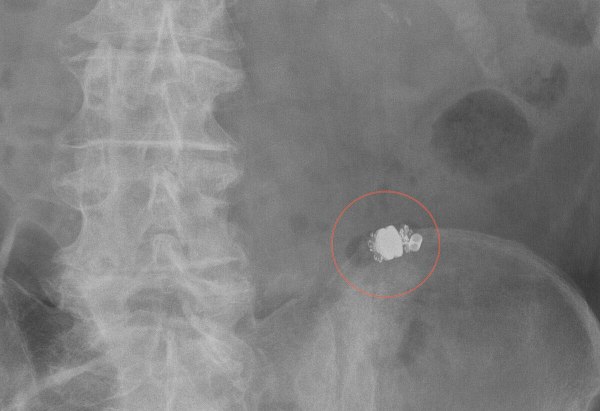Capsule endoscopy visible in an abdominal X-ray