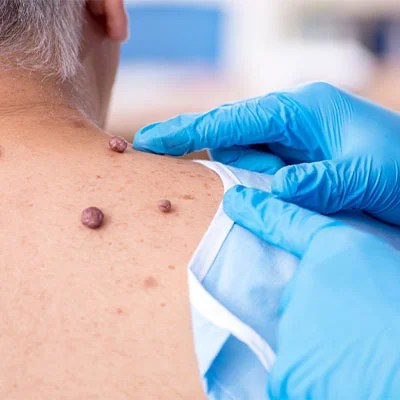 moles and cysts on a patient, in process of removal