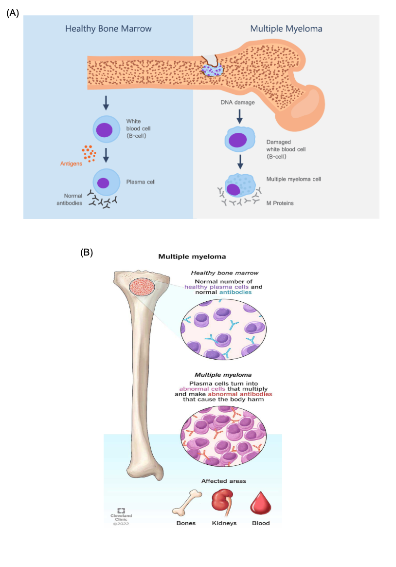 Abnormal Formation Of Bone Marrow Cells