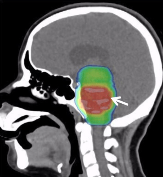 Treatment plan for a 16-year-old female with a diffuse intrinsic pontine glioma. Sagittal slice of a dose color wash of a 10-beam non-coplanar intensity-modulated radiation therapy (IMRT) plan (white arrows) to 54 Gy in 30 fractions.