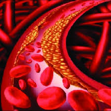 blood vessel with the plaque/hyperlipidemia