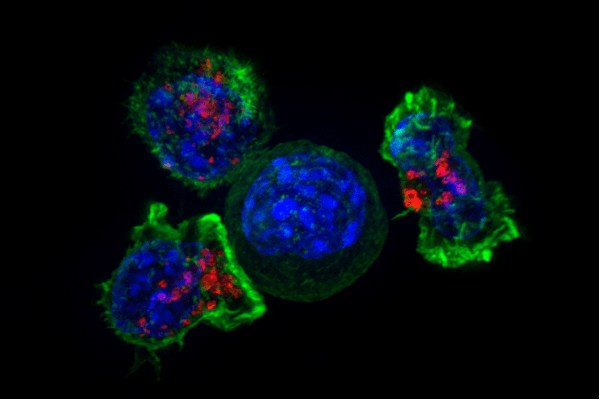 Representative image of T cells (outer green stain) surrounding cancer cells (inner blue stain). Red stain marks granules, which contain chemicals that can kill undesirable cells.