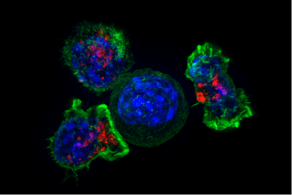 Representative image of T cells (outer green stain) surrounding cancer cells (inner blue stain). Red stain marks granules, which contain chemicals that can kill undesirable cells.