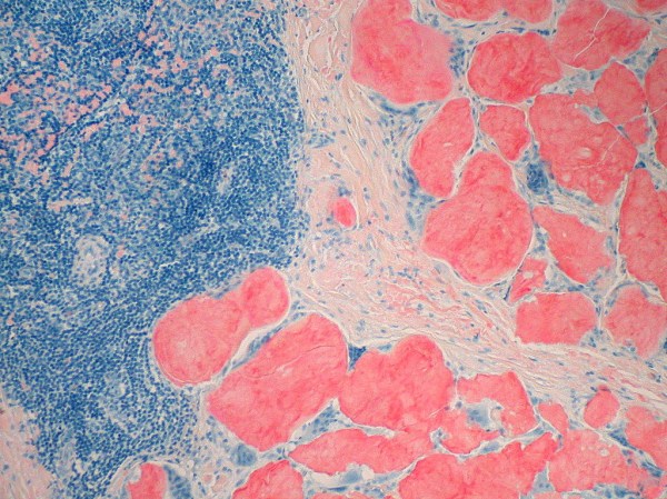 amyloid deposits in cell, stained with Congo dye for a better view